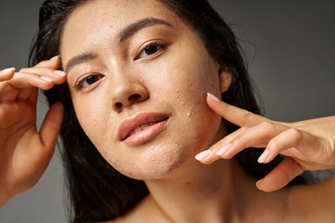 How to Build a Skincare Routine for Acne-Prone Skin