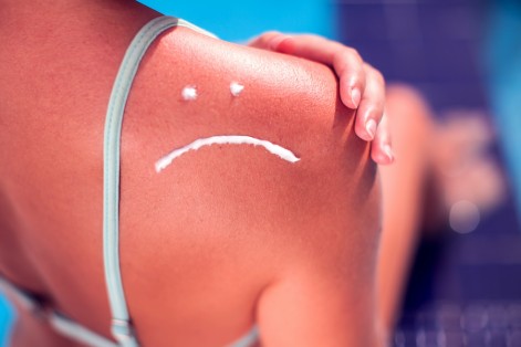 How to Care for Your Skin After a Sunburn: Expert Tips for Relief