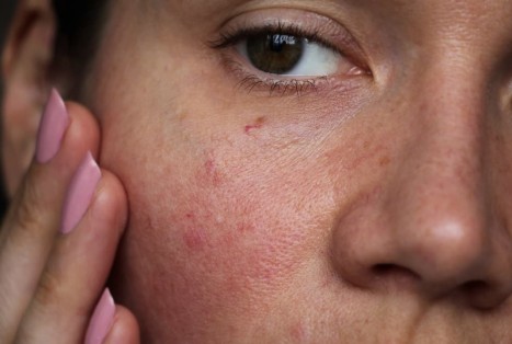 Is Your Skincare Routine Causing Inflammation? Understanding Skin Irritation